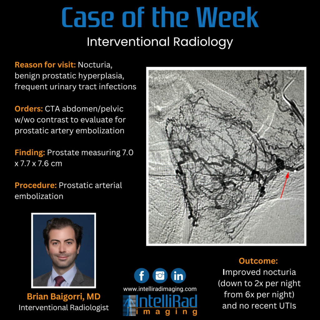 Case of the Week - prostatic artery embolization