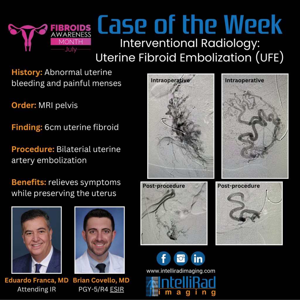 Case of the Week - Uterine Fibroid Embolization