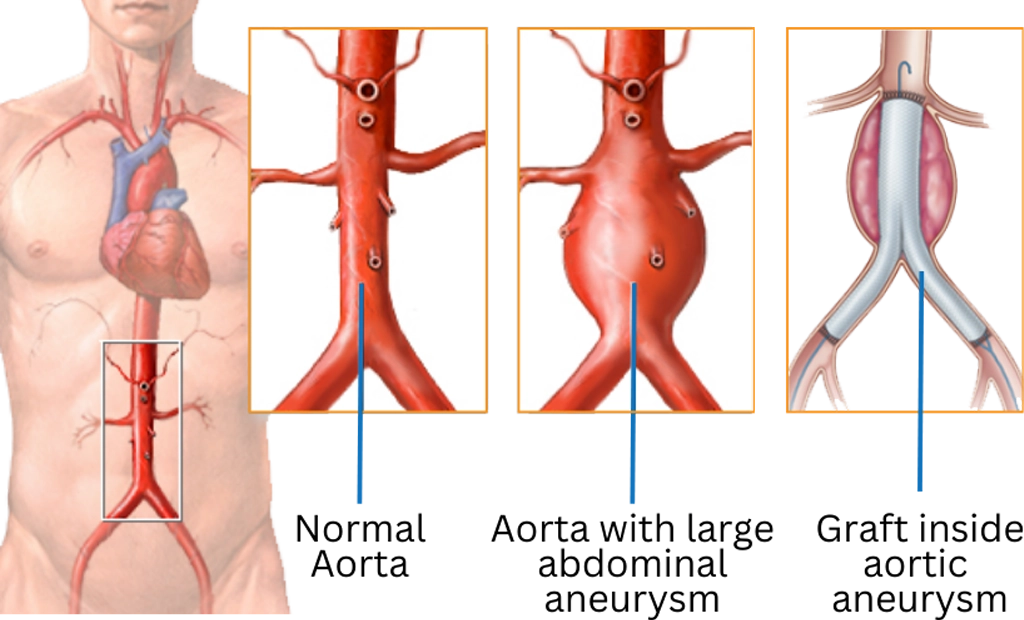 Abdominal Aortic Aneurysm