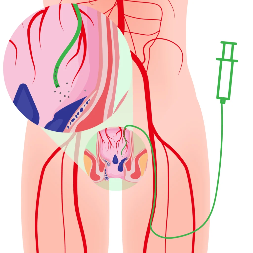 hemorrhoid treatment