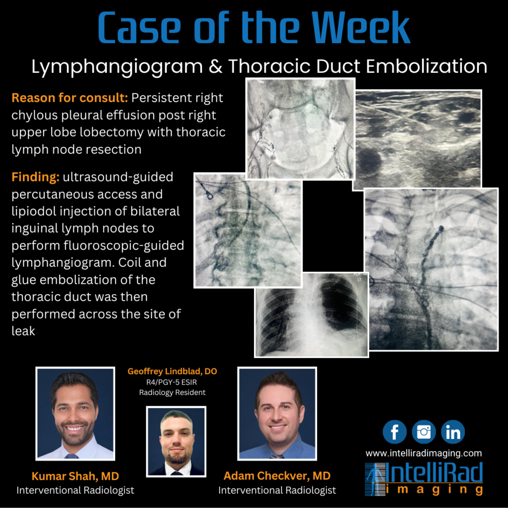 Case of the Week - Lymphangiogram & Thoracic Duct embolization