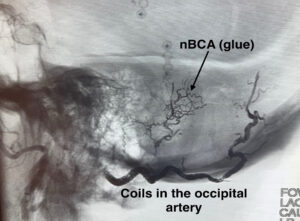 Pulsatile Tinnitus Findings
