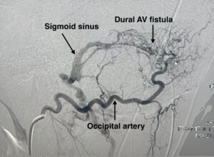 Pulsatile Tinnitus Imaging