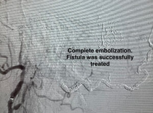 Pulsatile Tinnitus Results